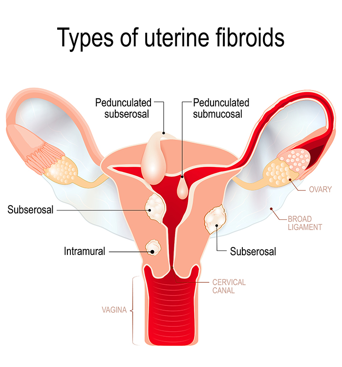 Types of Uterine Fibroids