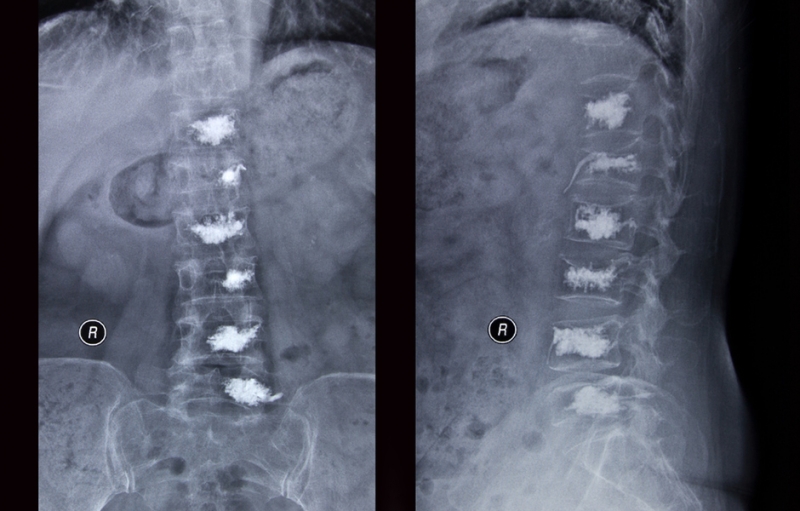 Radiograph of a vertebroplasty